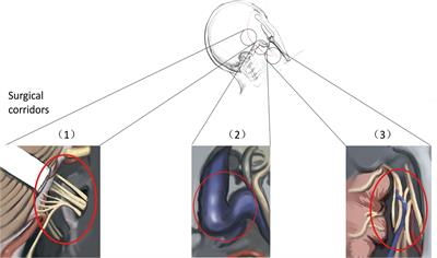 Efficacy of the Suboccipital Paracondylar-Lateral Cervical Approach: The Series of 64 Jugular Foramen Tumors Along With Follow-Up Data